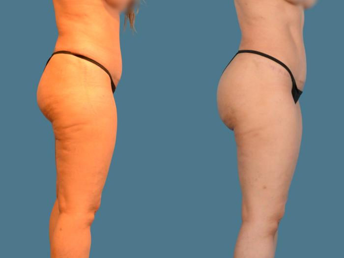 Before & After Butt Augmentation With Implants Case 834 Right Side View in Houston, TX