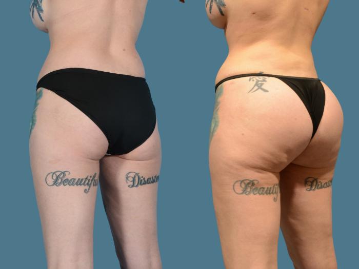Before & After Butt Augmentation With Implants Case 835 Left Oblique View in Houston, TX
