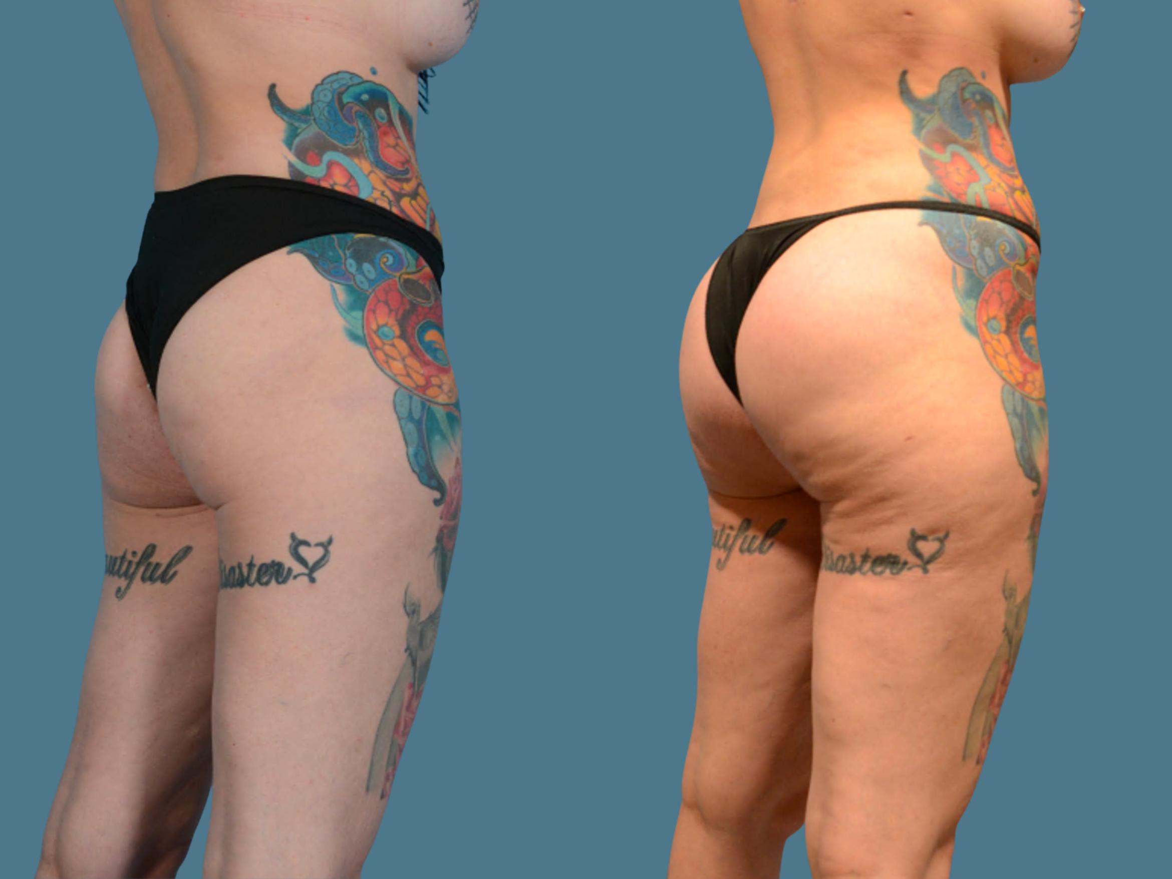 Before & After Butt Augmentation With Implants Case 835 Right Oblique View in Houston, TX