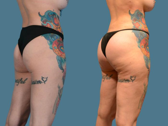 Before & After Butt Augmentation With Implants Case 835 Right Oblique View in Houston, TX