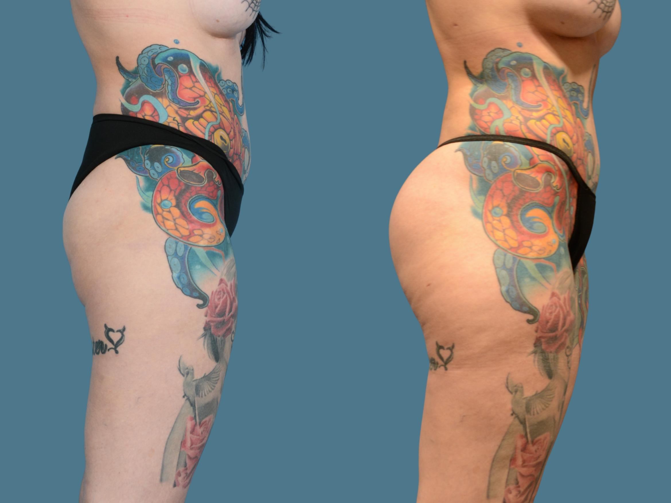 Before & After Butt Augmentation With Implants Case 835 Right Side View in Houston, TX