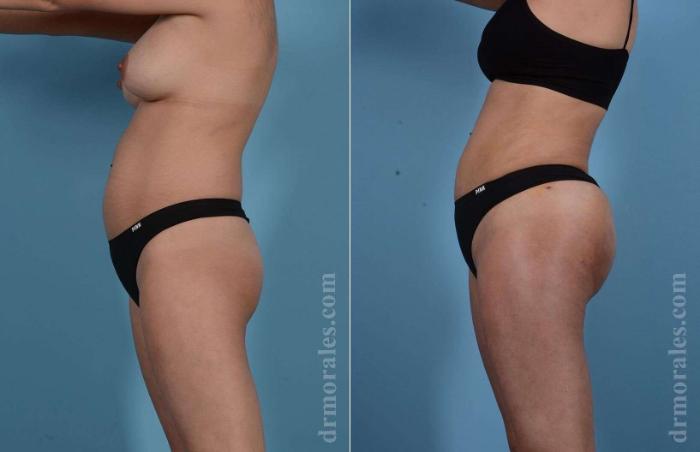 Before & After Butt Augmentation With Implants Case 84 View 1 View in Houston, TX