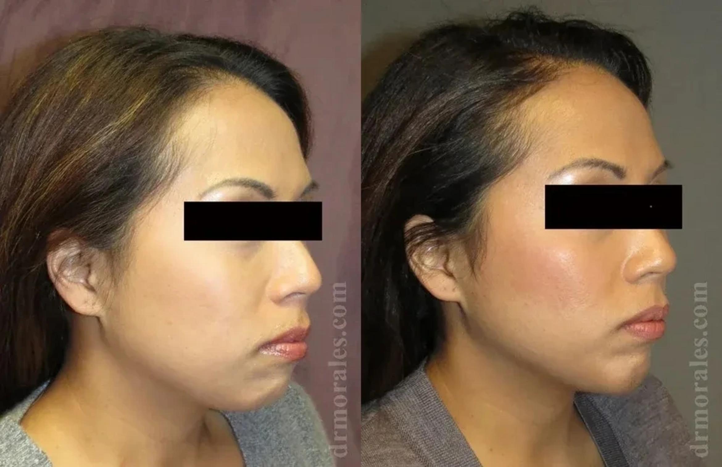 Before & After Chin Augmentation Case 176 View 1 View in Houston, TX