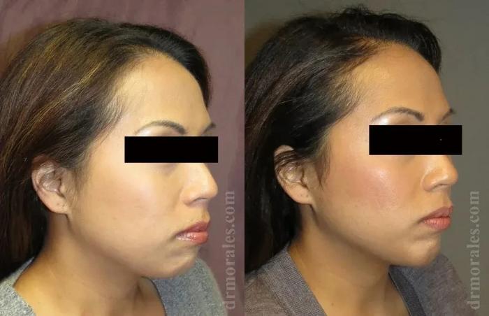 Before & After Chin Augmentation Case 176 View 1 View in Houston, TX