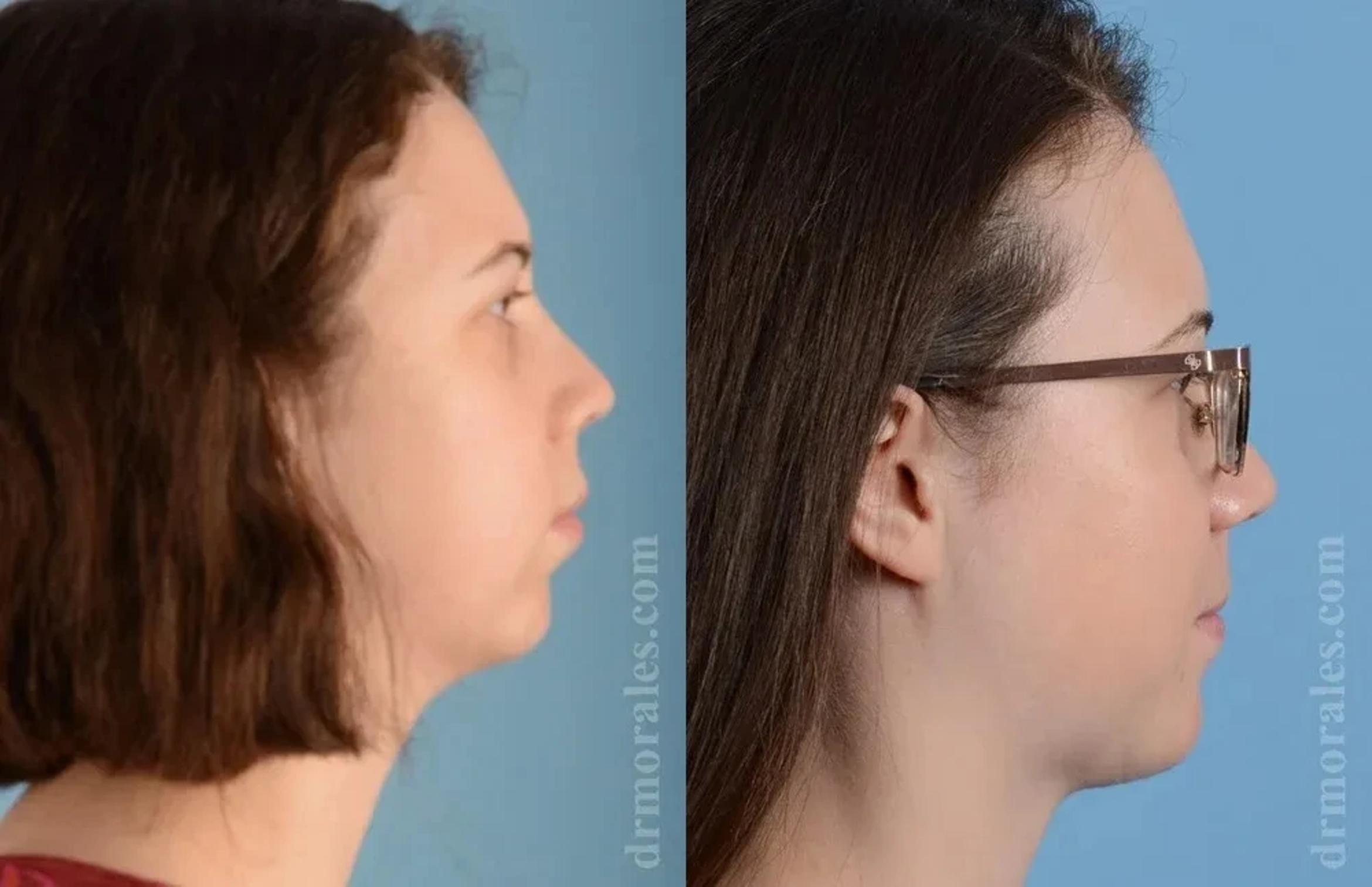 Before & After Chin Augmentation Case 177 View 1 View in Houston, TX