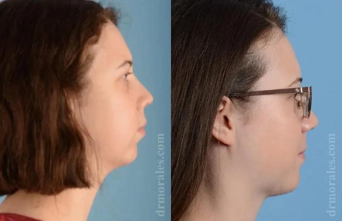 Before & After Chin Augmentation Case 177 View 1 View in Houston, TX