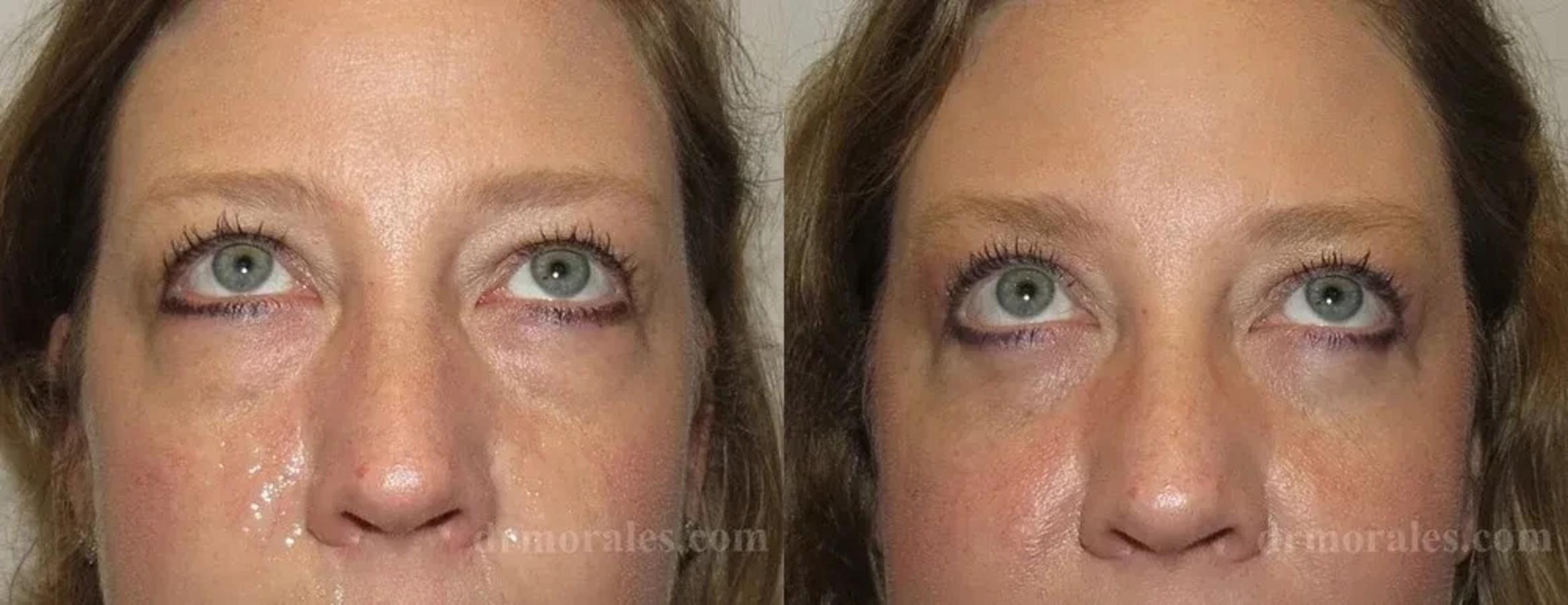 Before & After Eyelid Surgery Case 127 View 1 View in Houston, TX