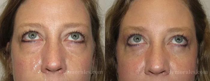 Before & After Eyelid Surgery Case 127 View 1 View in Houston, TX