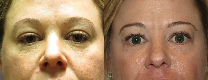 Before & After Eyelid Surgery Case 128 View 1 View in Houston, TX