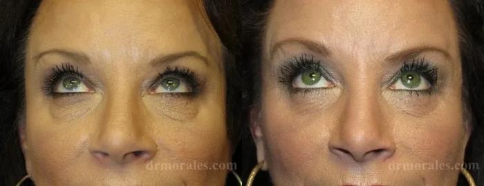 Before & After Eyelid Surgery Case 130 View 1 View in Houston, TX