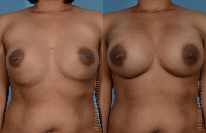 Before & After Fat Transfer Case 178 View 1 View in Houston, TX