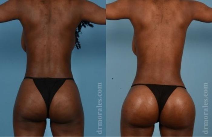 Before & After Fat Transfer Case 300 View 1 View in Houston, TX