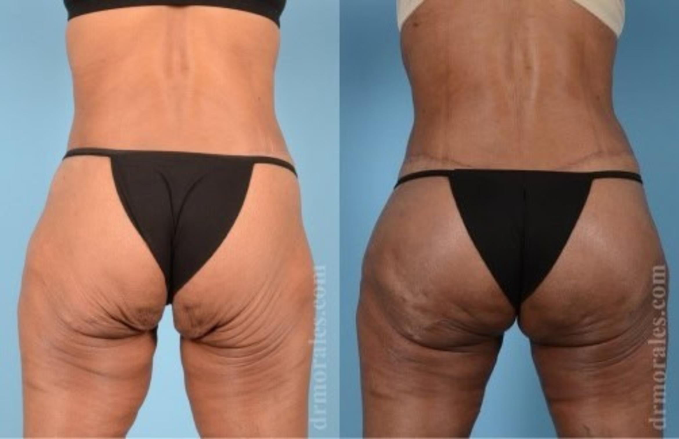 Before & After Fat Transfer Case 301 View 1 View in Houston, TX