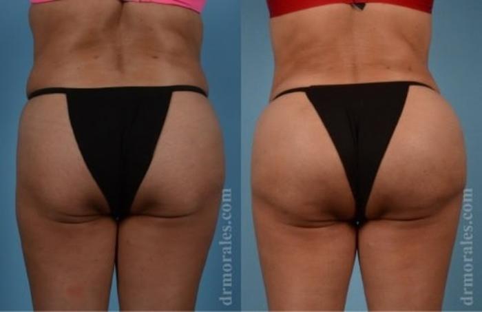 Before & After Fat Transfer Case 302 View 1 View in Houston, TX