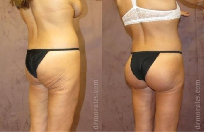 Before & After Fat Transfer Case 303 View 1 View in Houston, TX