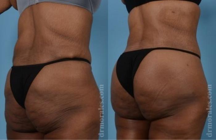 Before & After Fat Transfer Case 304 View 1 View in Houston, TX