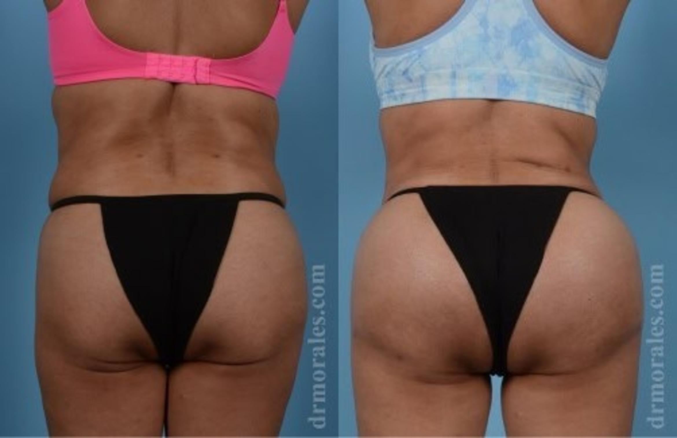 Before & After Fat Transfer Case 305 View 1 View in Houston, TX