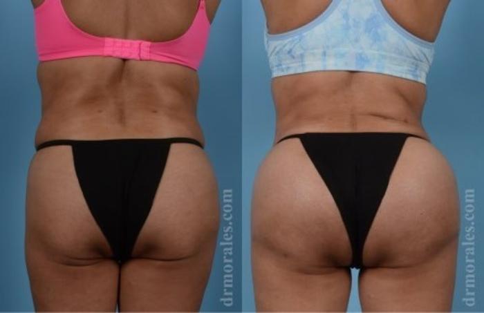 Before & After Fat Transfer Case 305 View 1 View in Houston, TX