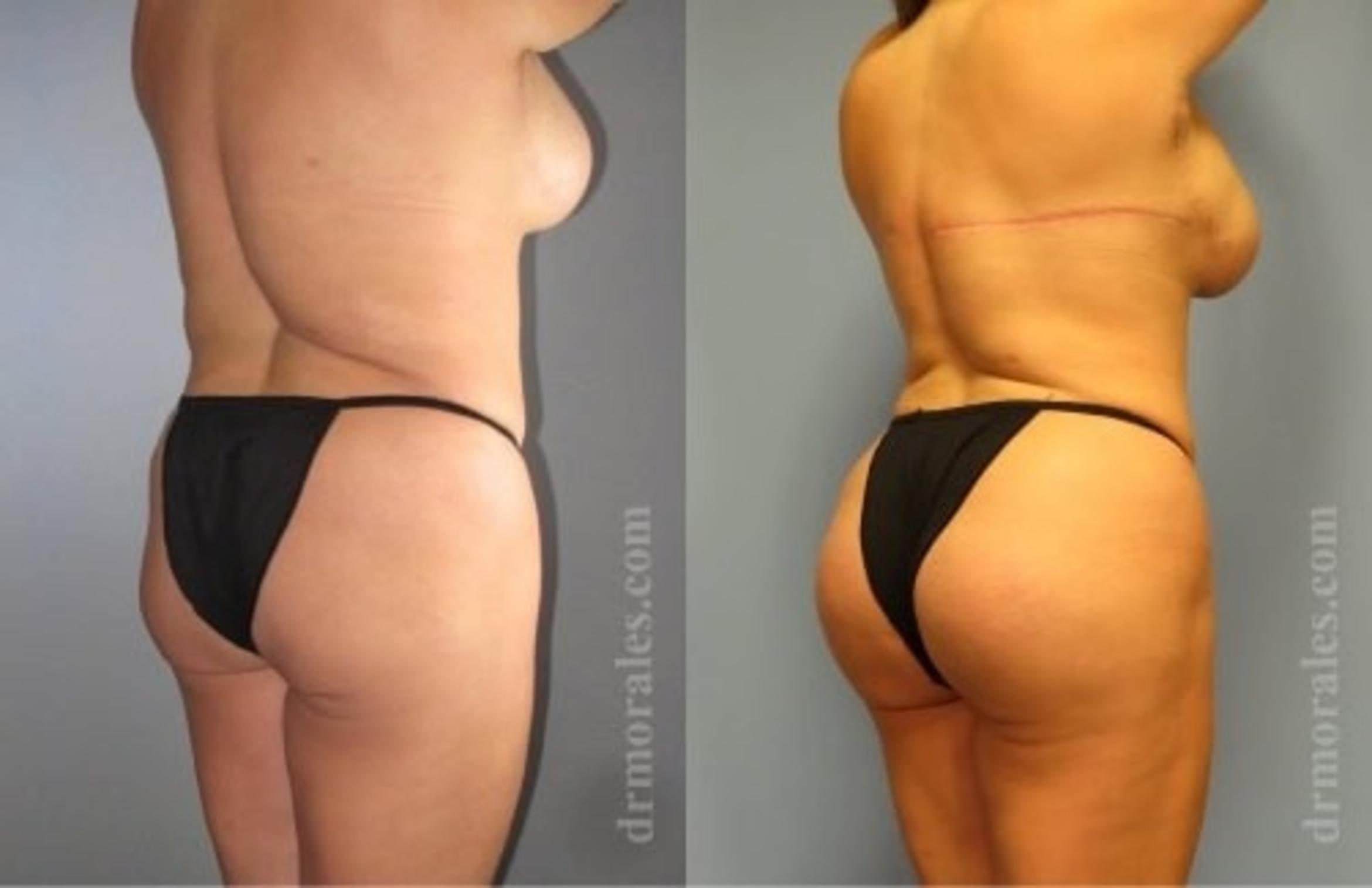 Before & After Fat Transfer Case 306 View 1 View in Houston, TX