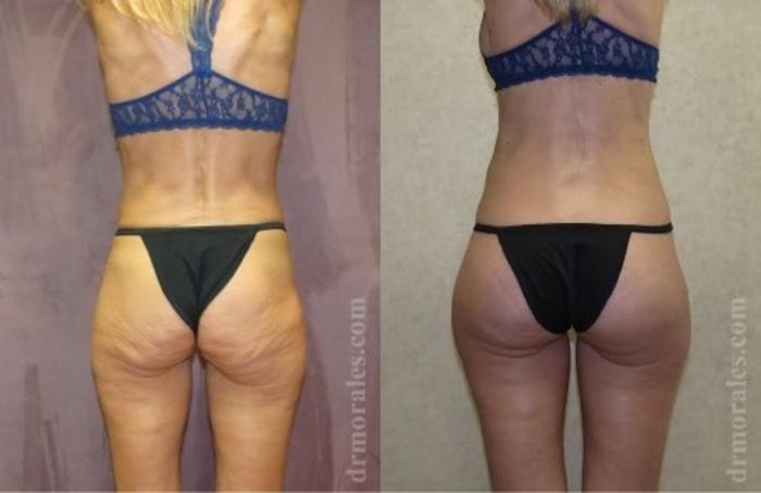 Before & After Fat Transfer Case 307 View 1 View in Houston, TX