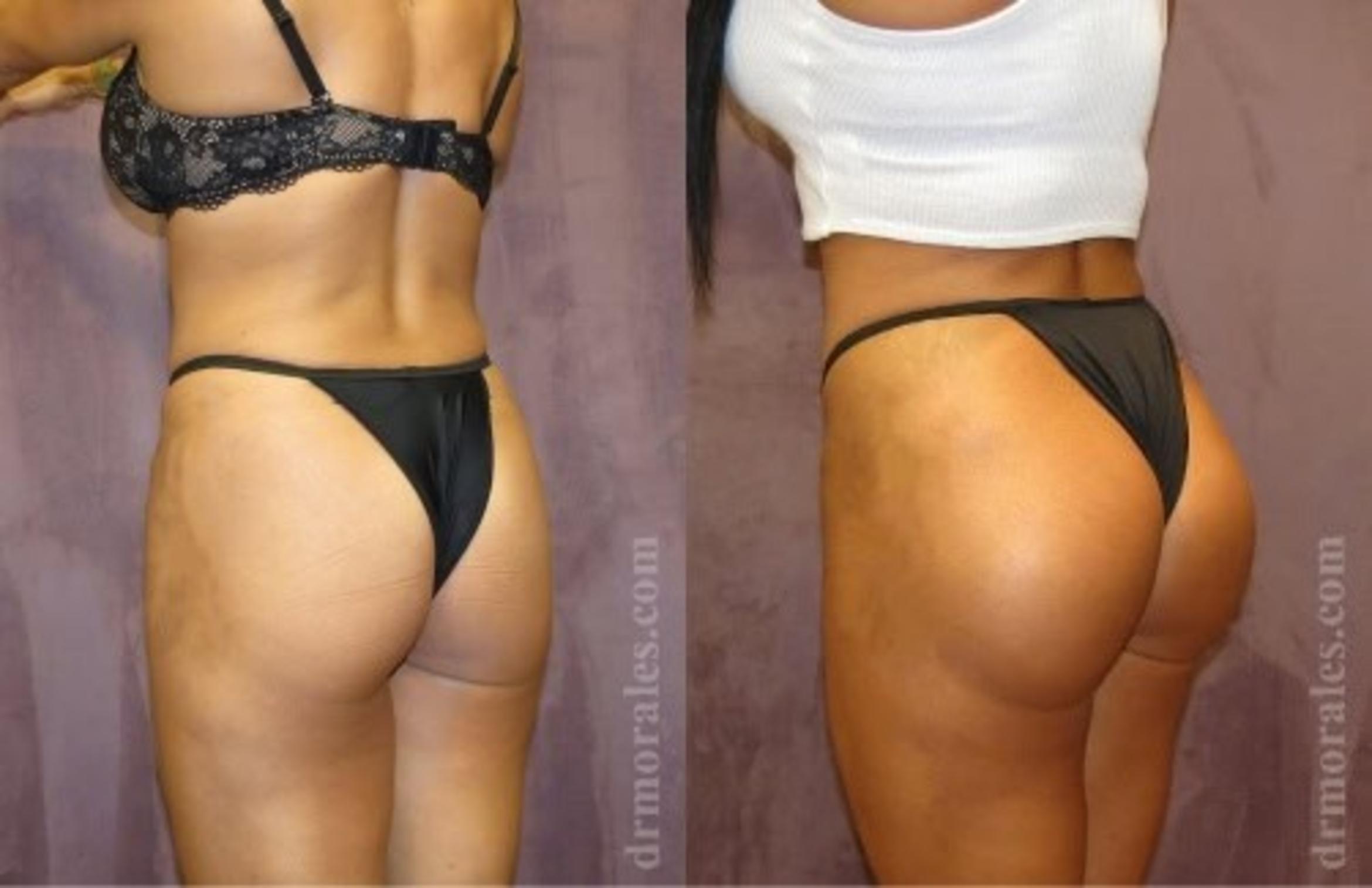 Before & After Fat Transfer Case 308 View 1 View in Houston, TX