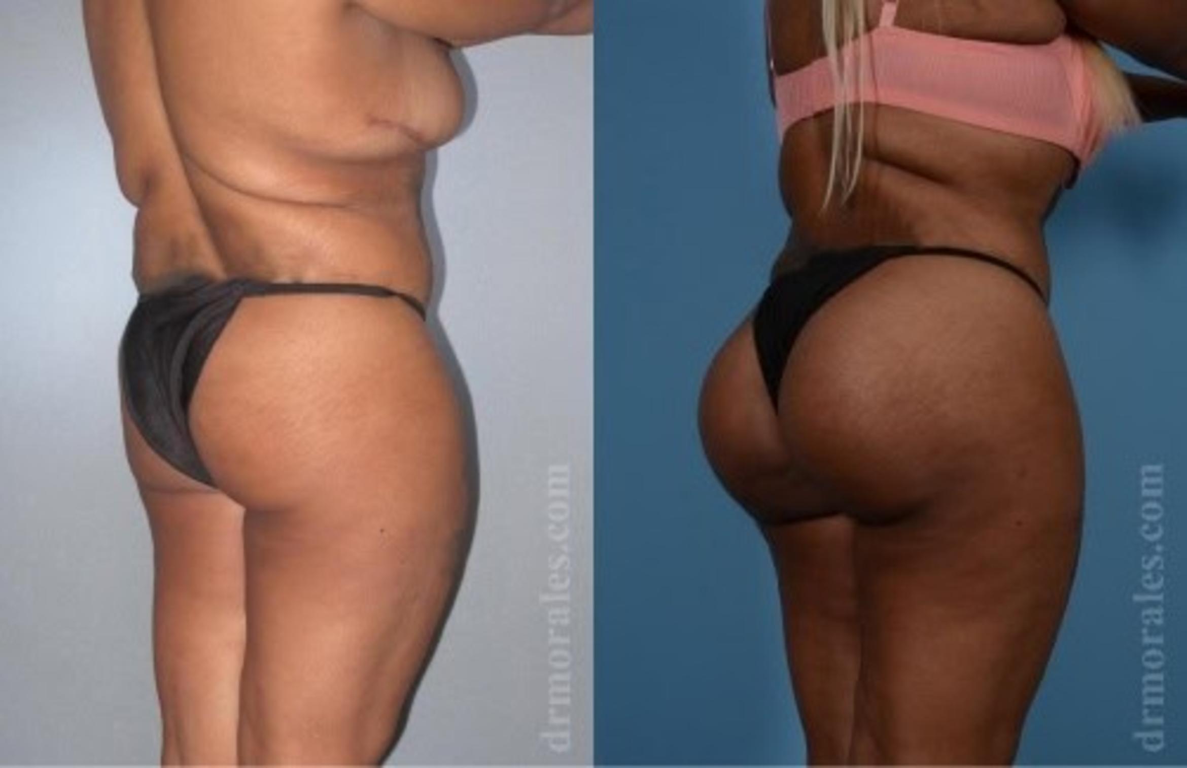 Before & After Fat Transfer Case 309 View 1 View in Houston, TX