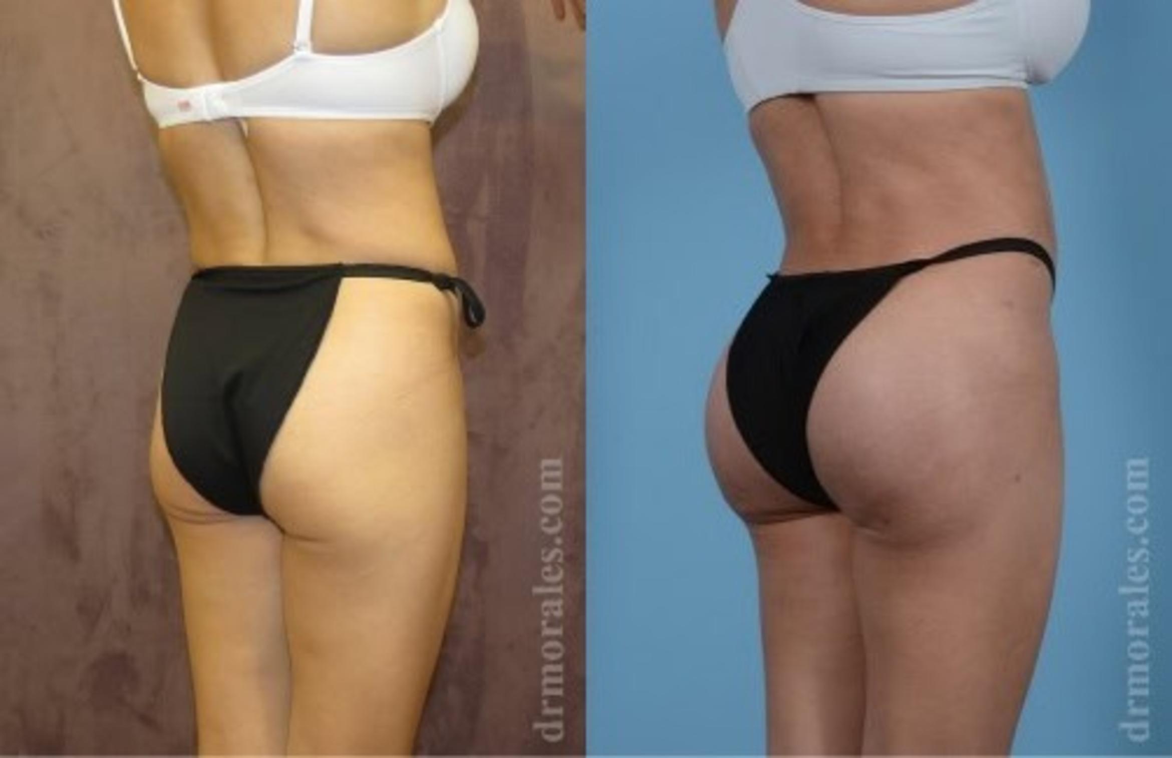 Before & After Fat Transfer Case 311 View 1 View in Houston, TX