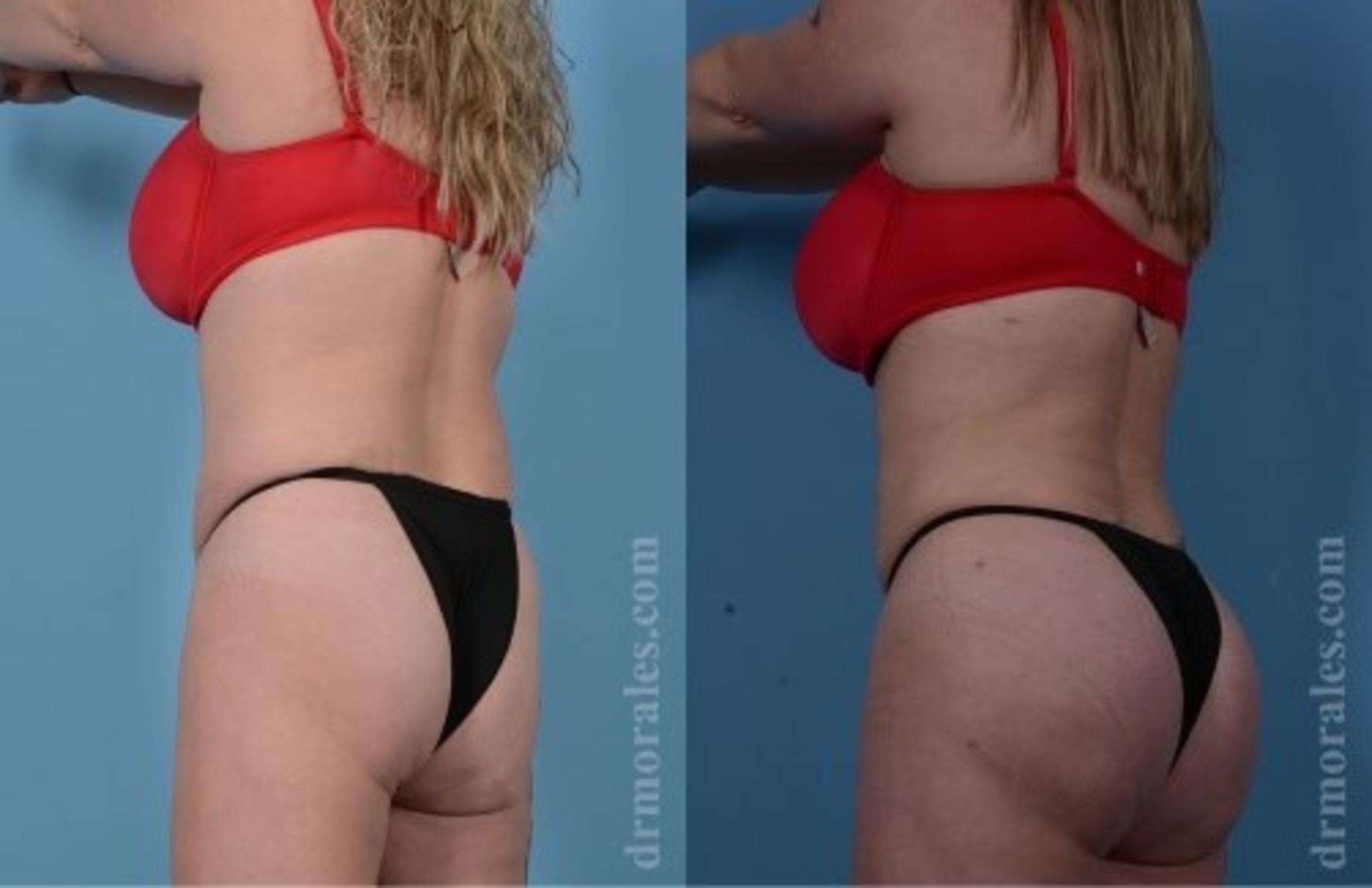 Before & After Fat Transfer Case 313 View 1 View in Houston, TX