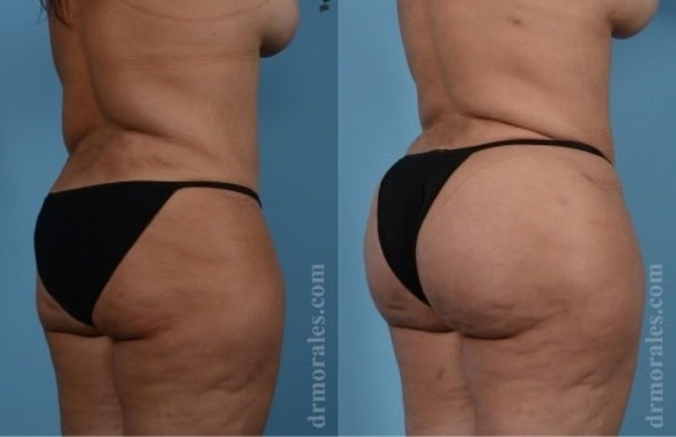 Before & After Fat Transfer Case 315 View 1 View in Houston, TX