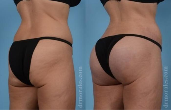 Before & After Fat Transfer Case 316 View 1 View in Houston, TX