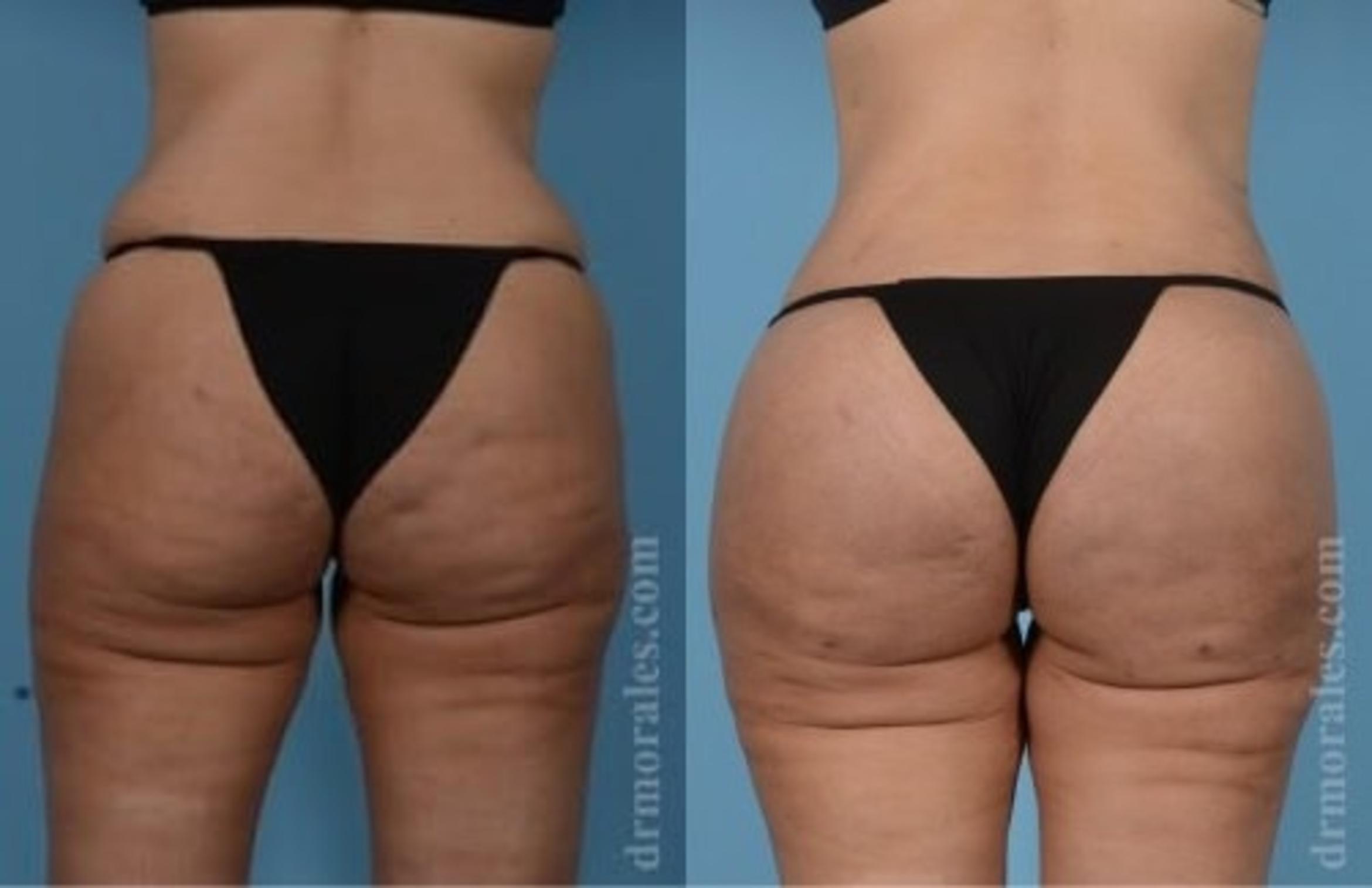 Before & After Fat Transfer Case 317 View 1 View in Houston, TX