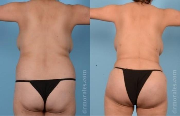 Before & After Fat Transfer Case 318 View 1 View in Houston, TX