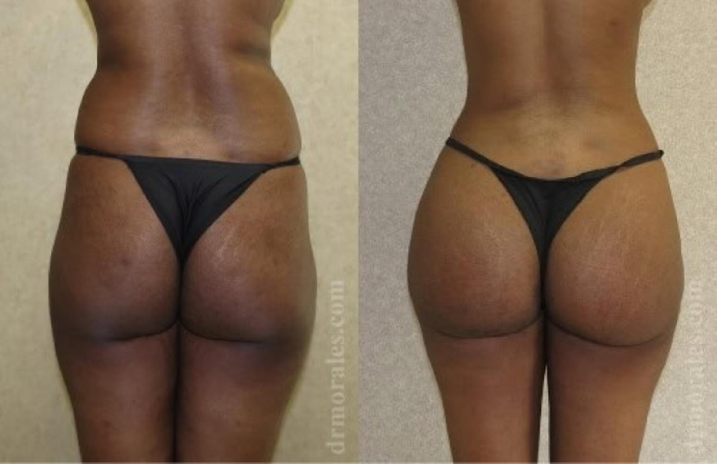 Before & After Fat Transfer Case 319 View 1 View in Houston, TX