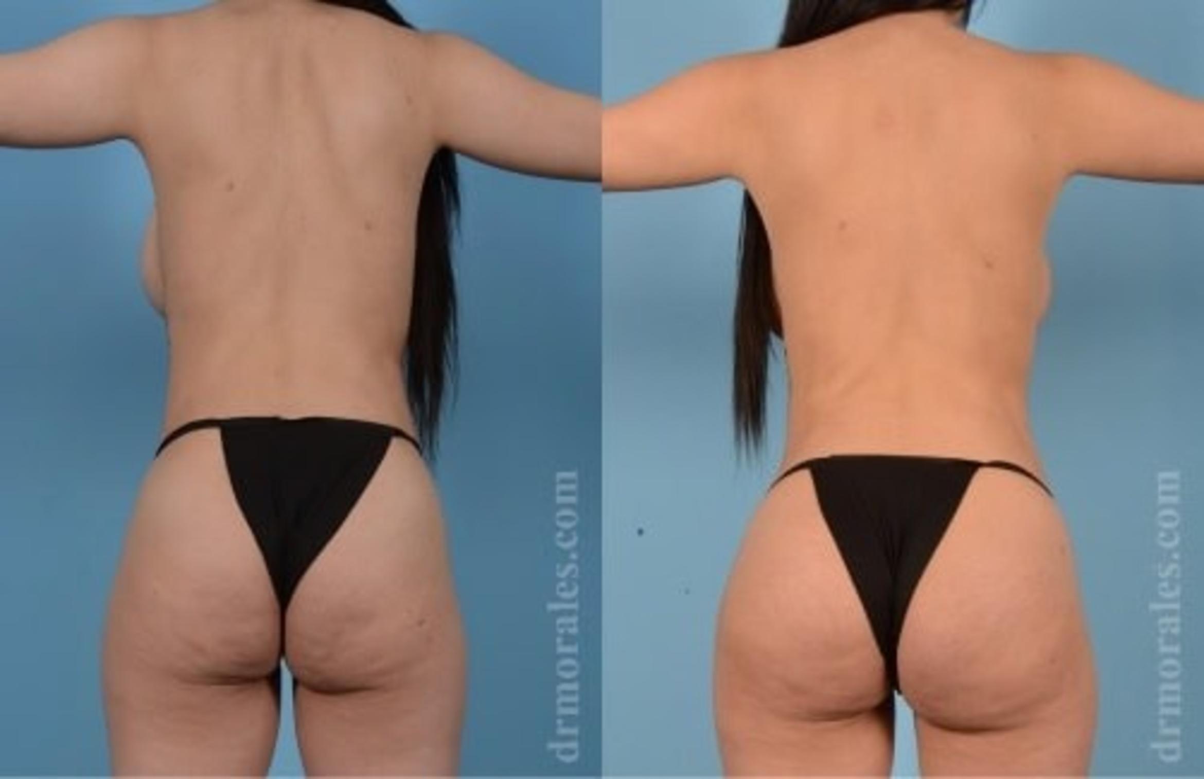 Before & After Fat Transfer Case 321 View 1 View in Houston, TX