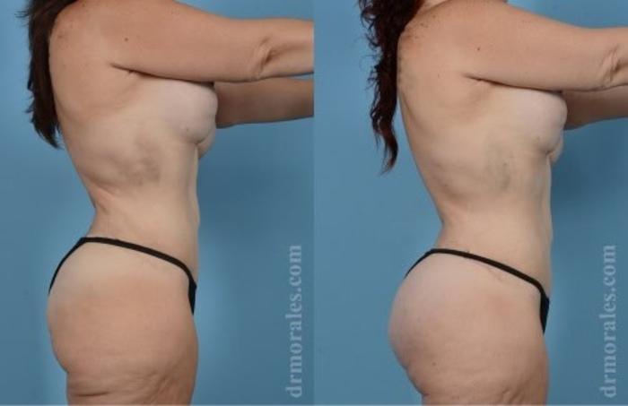 Before & After Fat Transfer Case 322 View 1 View in Houston, TX