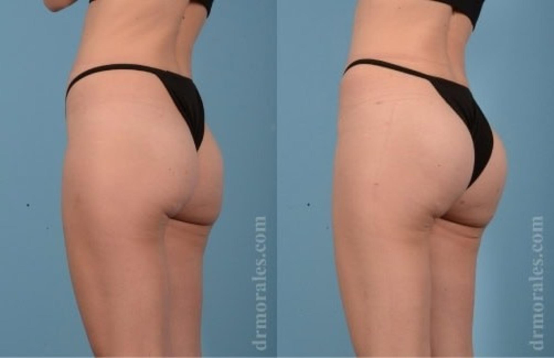 Before & After Fat Transfer Case 323 View 1 View in Houston, TX