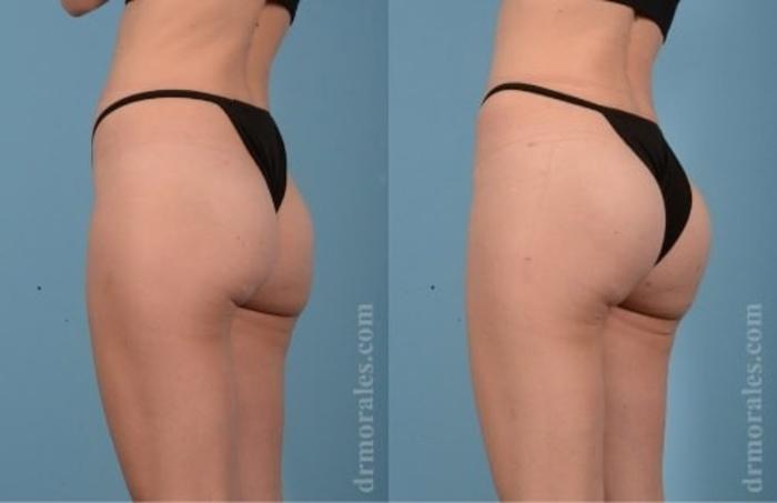 Before & After Fat Transfer Case 323 View 1 View in Houston, TX