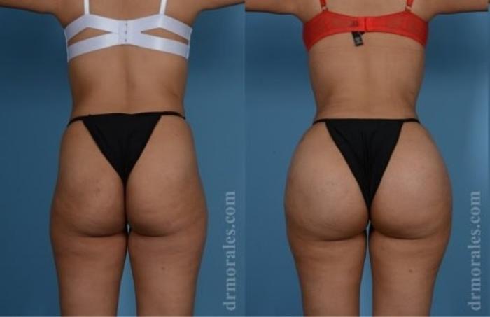 Before & After Fat Transfer Case 324 View 1 View in Houston, TX