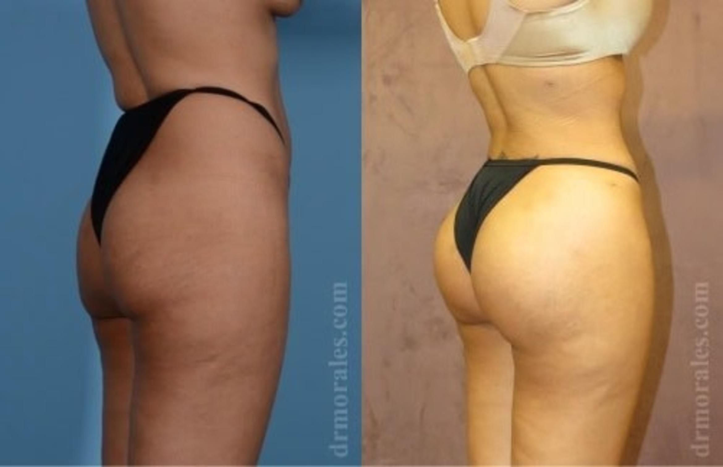 Before & After Fat Transfer Case 325 View 1 View in Houston, TX