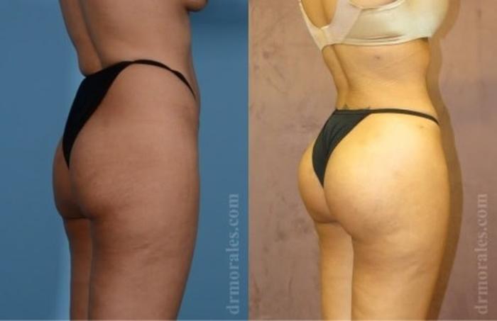 Before & After Fat Transfer Case 325 View 1 View in Houston, TX