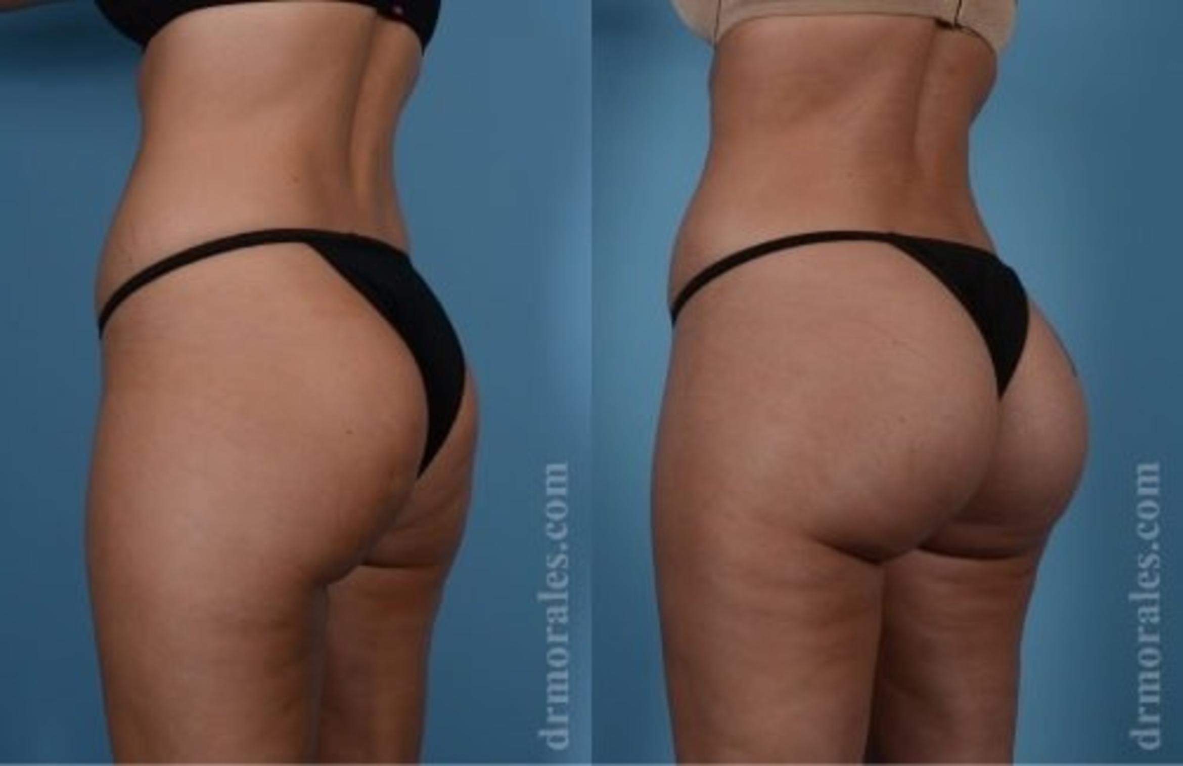 Before & After Fat Transfer Case 326 View 1 View in Houston, TX