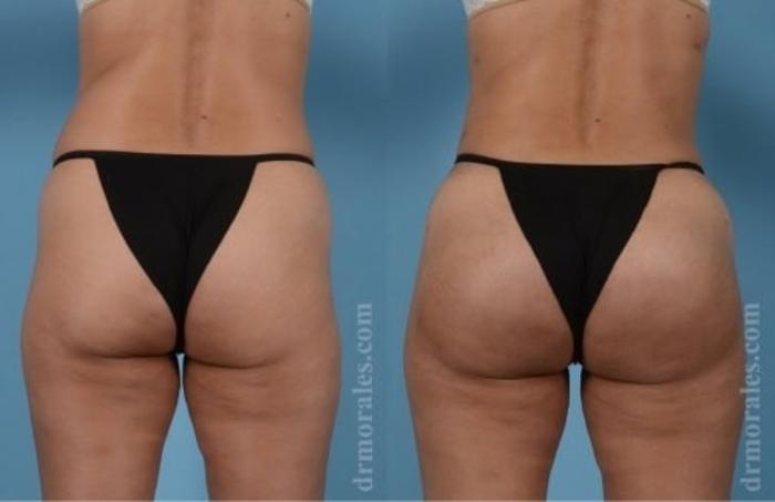 Before & After Fat Transfer Case 327 View 1 View in Houston, TX