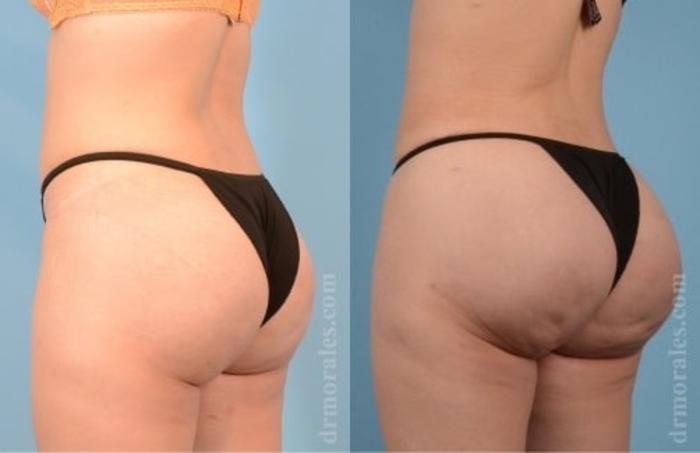 Before & After Fat Transfer Case 328 View 1 View in Houston, TX