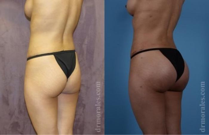 Before & After Fat Transfer Case 329 View 1 View in Houston, TX