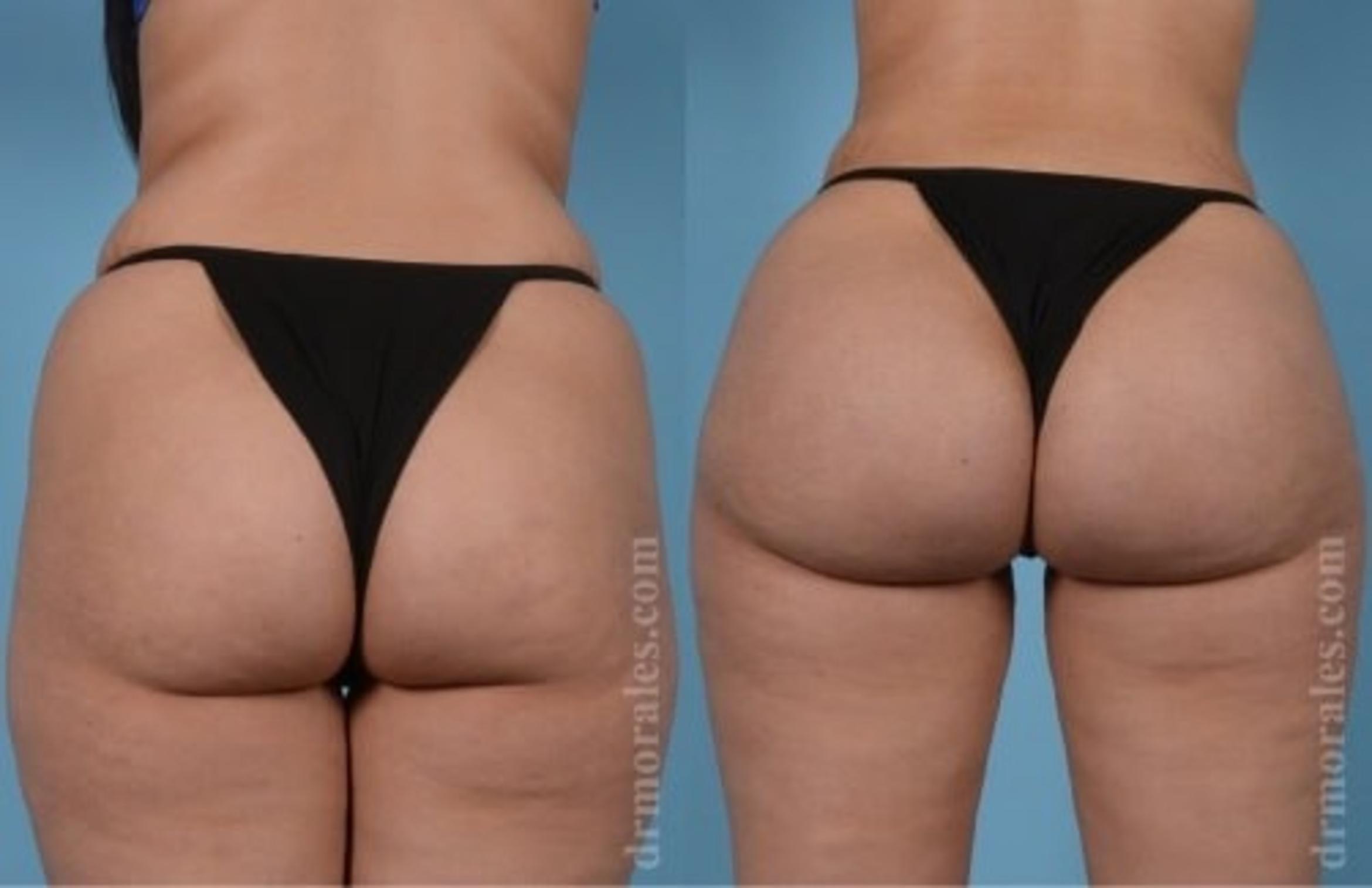 Before & After Fat Transfer Case 331 View 1 View in Houston, TX