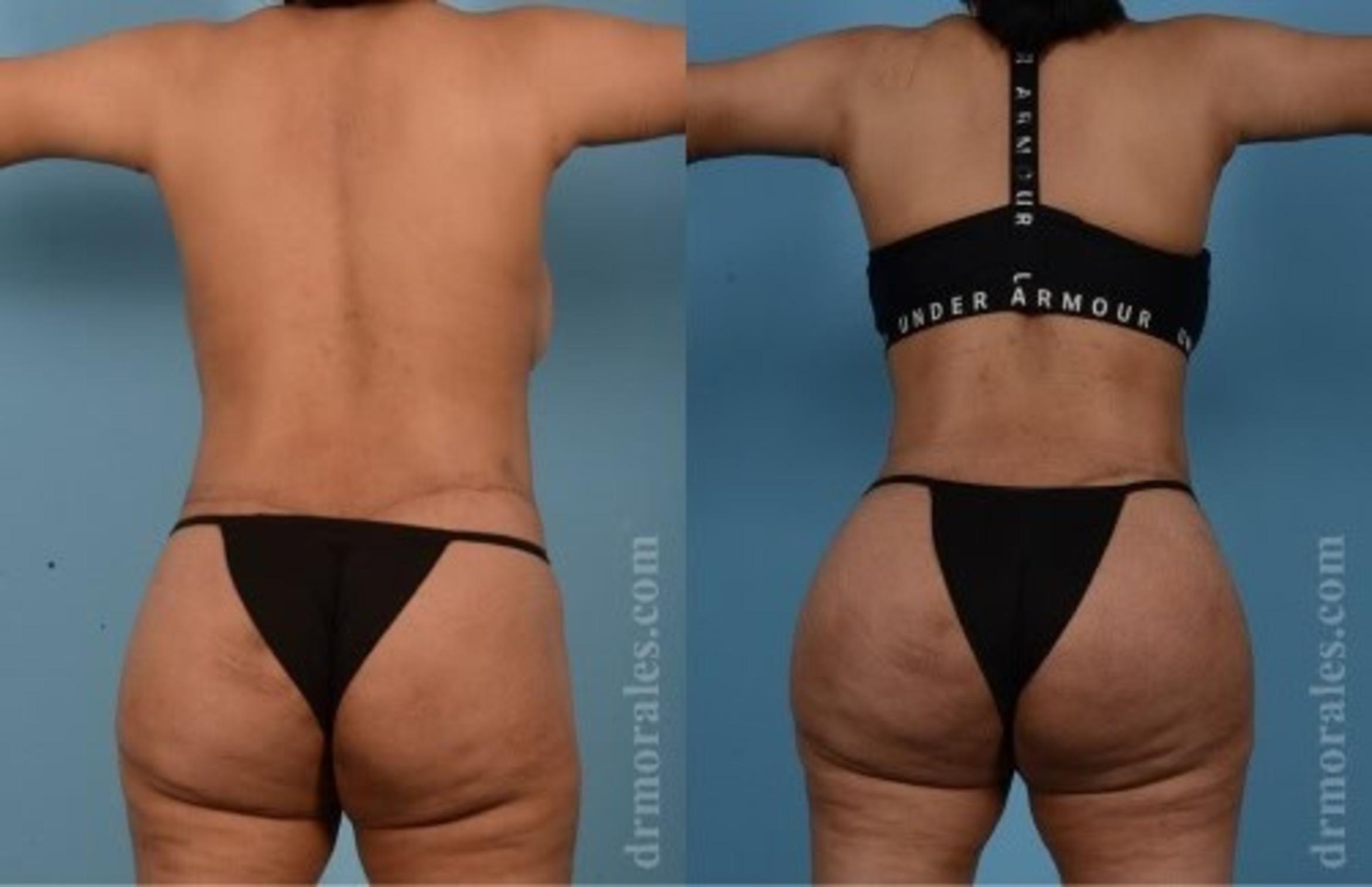 Before & After Fat Transfer Case 334 View 1 View in Houston, TX