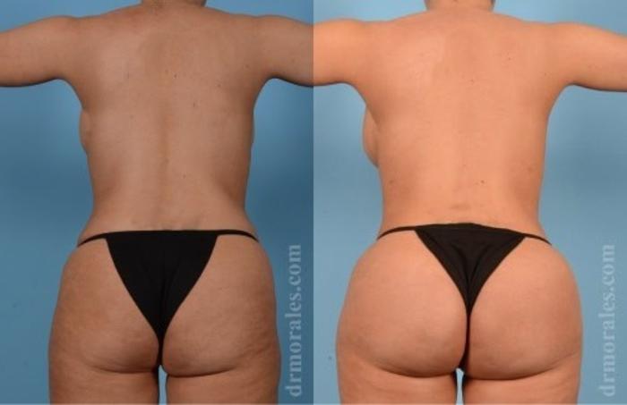 Before & After Fat Transfer Case 339 View 1 View in Houston, TX