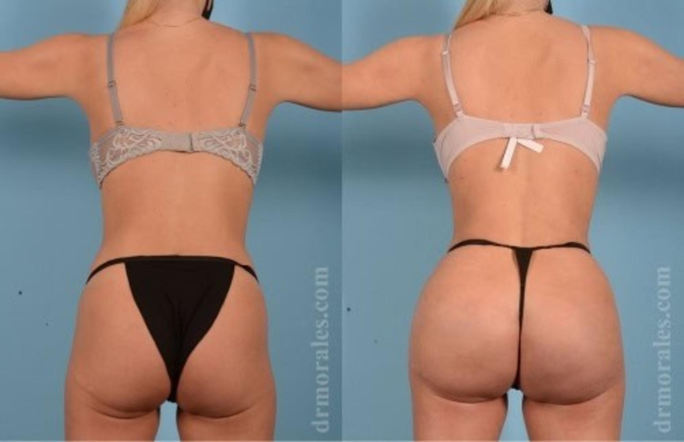 Before & After Fat Transfer Case 340 View 1 View in Houston, TX