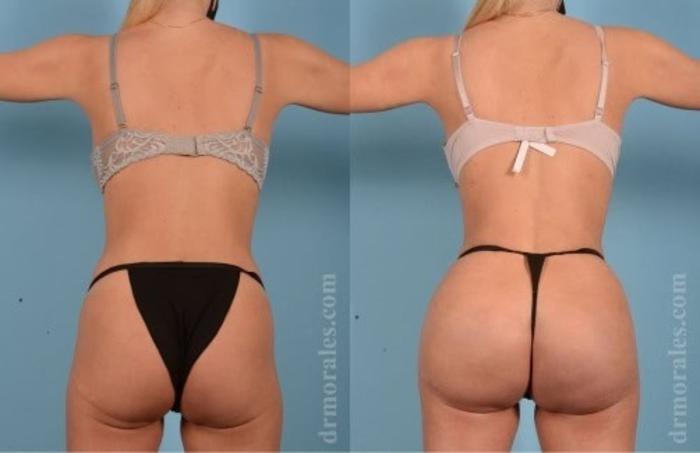 Before & After Fat Transfer Case 340 View 1 View in Houston, TX