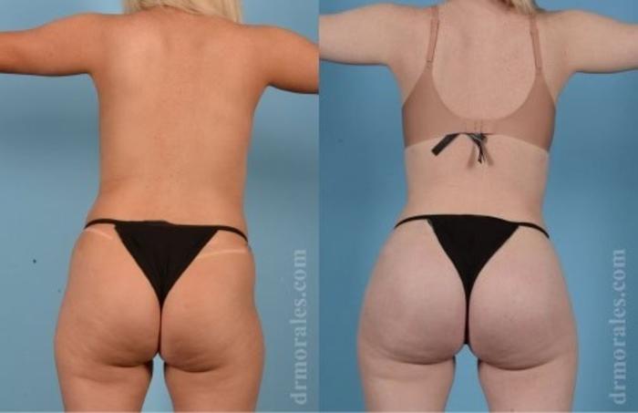 Before & After Fat Transfer Case 341 View 1 View in Houston, TX